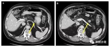 胃肠道间质瘤视频讲解,深入解析诊断与治疗策略
