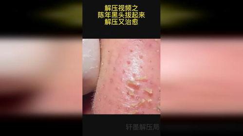 拔黑头粉刺视频